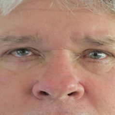 How Glaucoma Treatment in Honolulu Can Help You