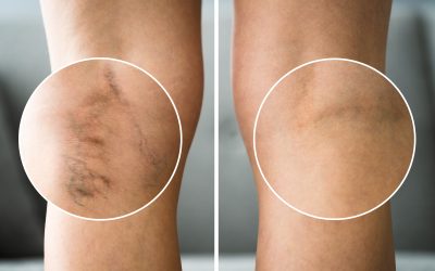 Your Primary Care Doctor Suggests You See a Vein Specialist in Indiana