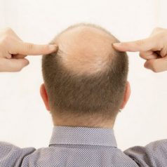 Who Makes the Best Candidates for Hair Restoration in New Jersey?