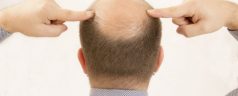 Who Makes the Best Candidates for Hair Restoration in New Jersey?