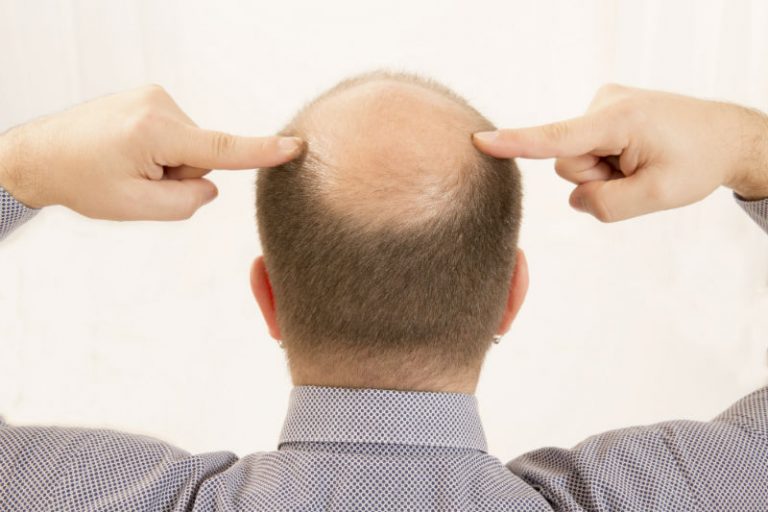 Who Makes the Best Candidates for Hair Restoration in New Jersey?