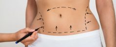 How the Tummy Tuck Procedure Can Improve Your Midsection and Confidence
