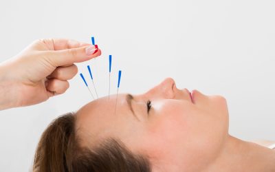 Unravel the Benefits of Acupuncture Treatment at Toluca Lake CA Clinics