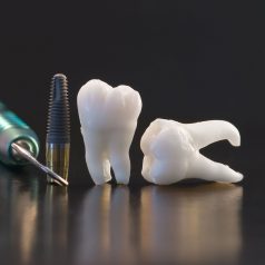 Dental Implants: Why it’s the Right Treatment for You
