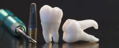 Dental Implants: Why it’s the Right Treatment for You
