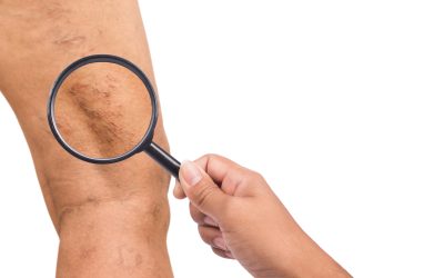 Find Relief From Leg Swelling in San Bernardino, CA, With Effective Local Treatment Options