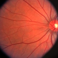 Glaucoma in Cincinnati, OH – Reasons, Symptoms and Treatment