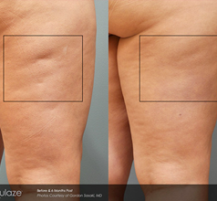 4 Things to Know about Varicose Veins