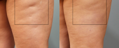 4 Things to Know about Varicose Veins